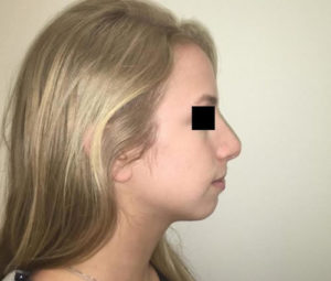 Rhinoplasty DC after
