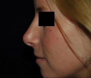 Rhinoplasty DC nose surgery after