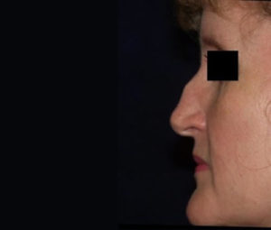 Rhinoplasty DC nose surgery before