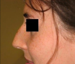 Rhinoplasty DC nose surgery before