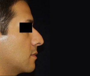 Rhinoplasty DC nose surgery before