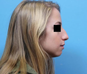 Rhinoplasty DC nose surgery before
