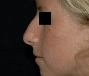 Rhinoplasty DC nose surgery before