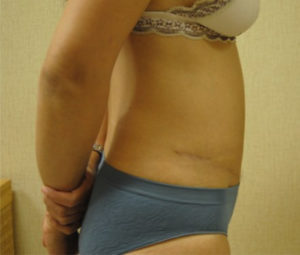 Tummy tuck front after
