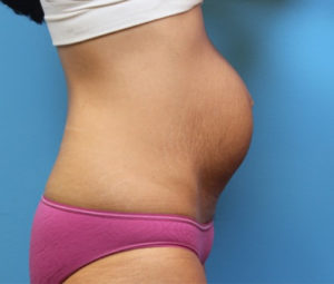 Tummy tuck front before