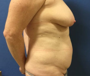 Tummy tuck side before
