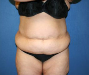 Tummy Tuck Before