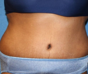 Tummy tuck front after
