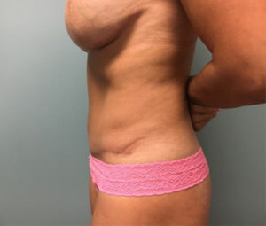 After Tummy Tuck