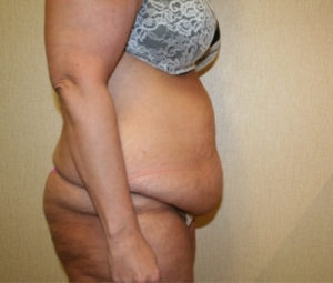 Tummy tuck side before