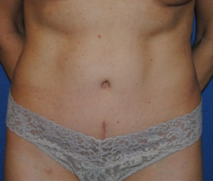 Tummy tuck front after