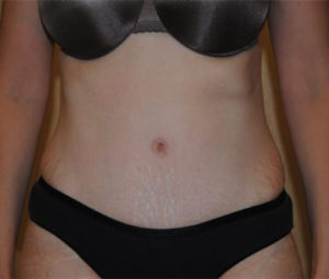 Tummy tuck front after