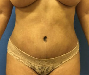 Tummy tuck front after