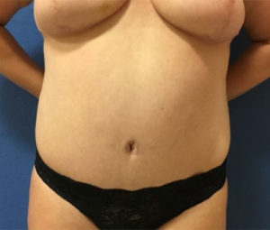 Tummy tuck front after