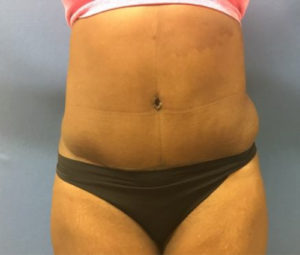 Tummy tuck front after