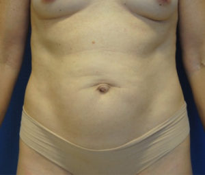 Tummy tuck front before