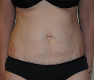 Tummy tuck front before