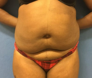 Tummy tuck front before