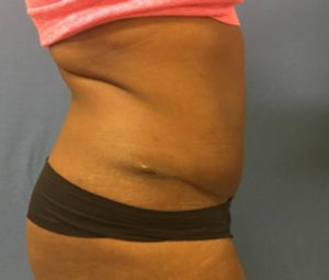 Tummy tuck side after