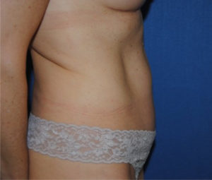 Tummy tuck side after