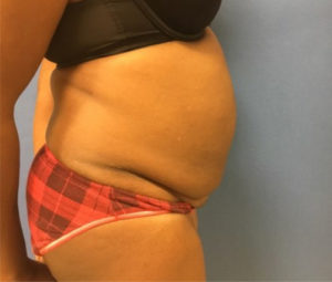 Tummy tuck side before