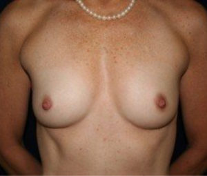 DC Breast Augmentation