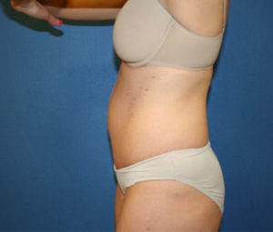 Tummy Tuck After