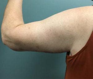 Armlift After Back