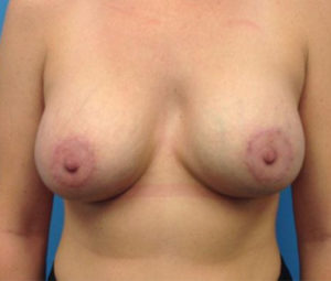 Breast Augmentation