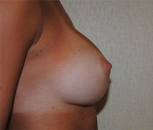 Breast Augmentation