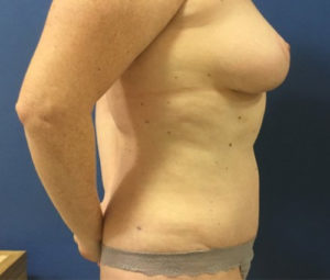 Tummy tuck side after
