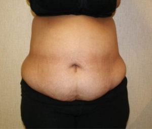 Tummy tuck front before