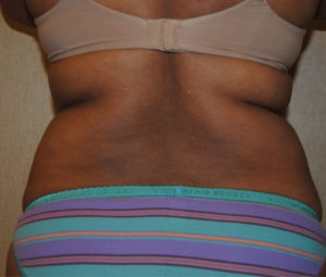 Tummy Tuck before