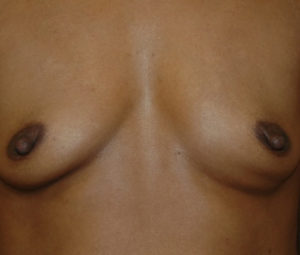 beforebreast (1)