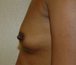 beforebreastside (1)