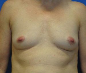 Breast Augmentation