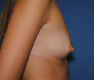 Breast Augmentation