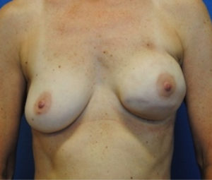 Breast Reconstruction