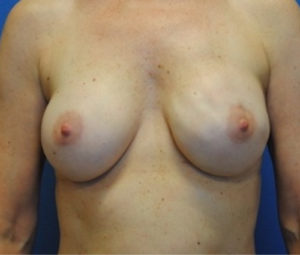 Breast Reconstruction