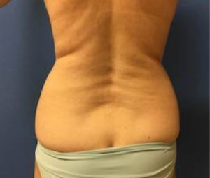 Laser Lipo