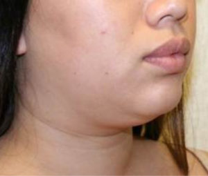 Laser Lipo
