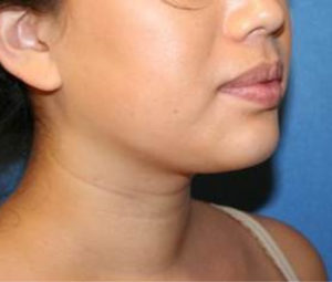 Laser Lipo