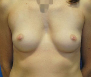 Breast Augmentation