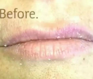 Dermal Fillers