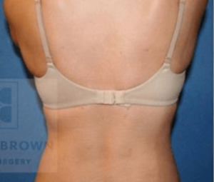 Laser Lipo