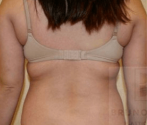 Laser Lipo