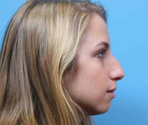 Rhinoplasty