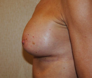 sidebreastafter (1)