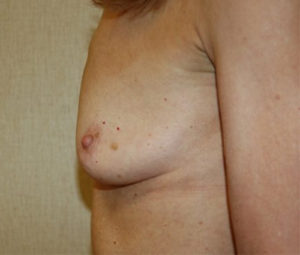 sidebreastbefore (1)