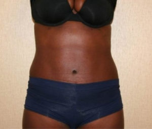 Tummy tuck front after